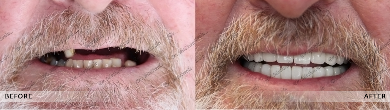 Dental sinus lift surgery in India