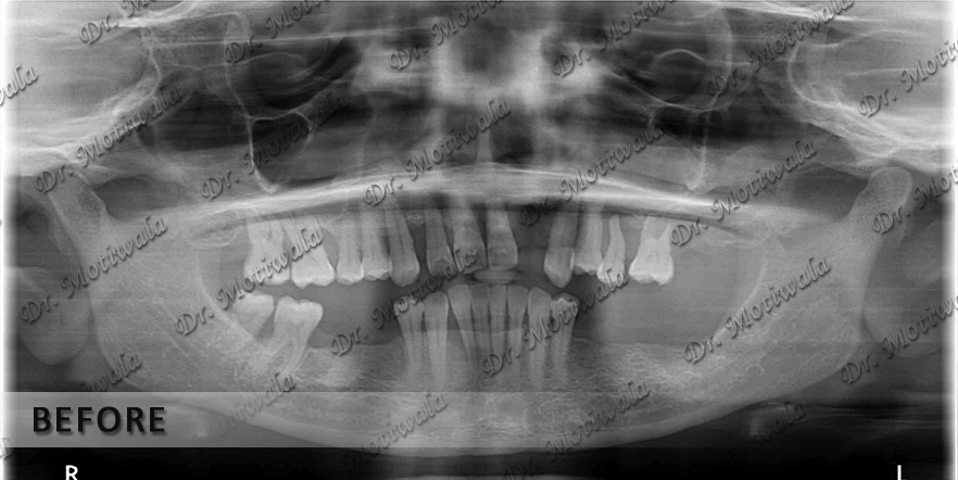 Tuberopterygoid implants