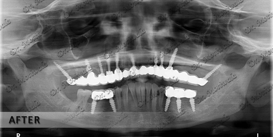 Tuberopterygoid implants