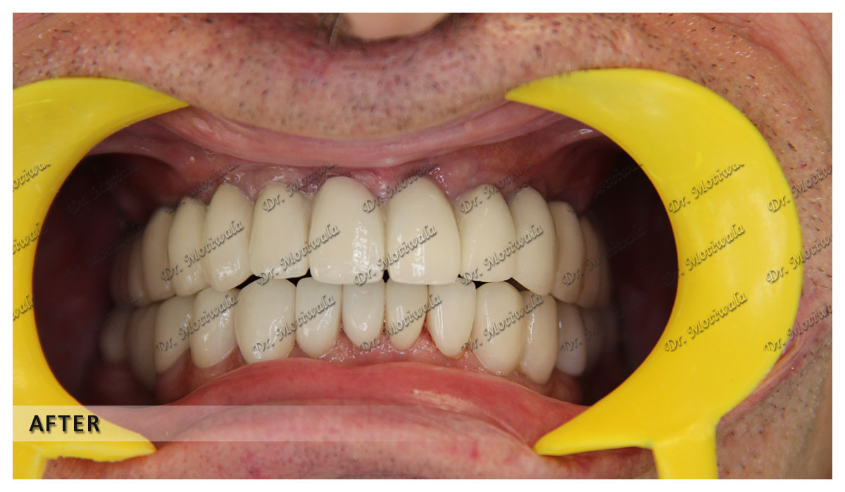 Permanent teeth implants in 3 days