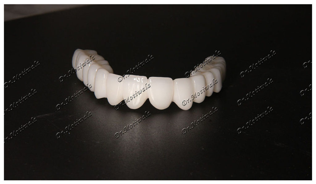 Zirconium Crowns Are Better