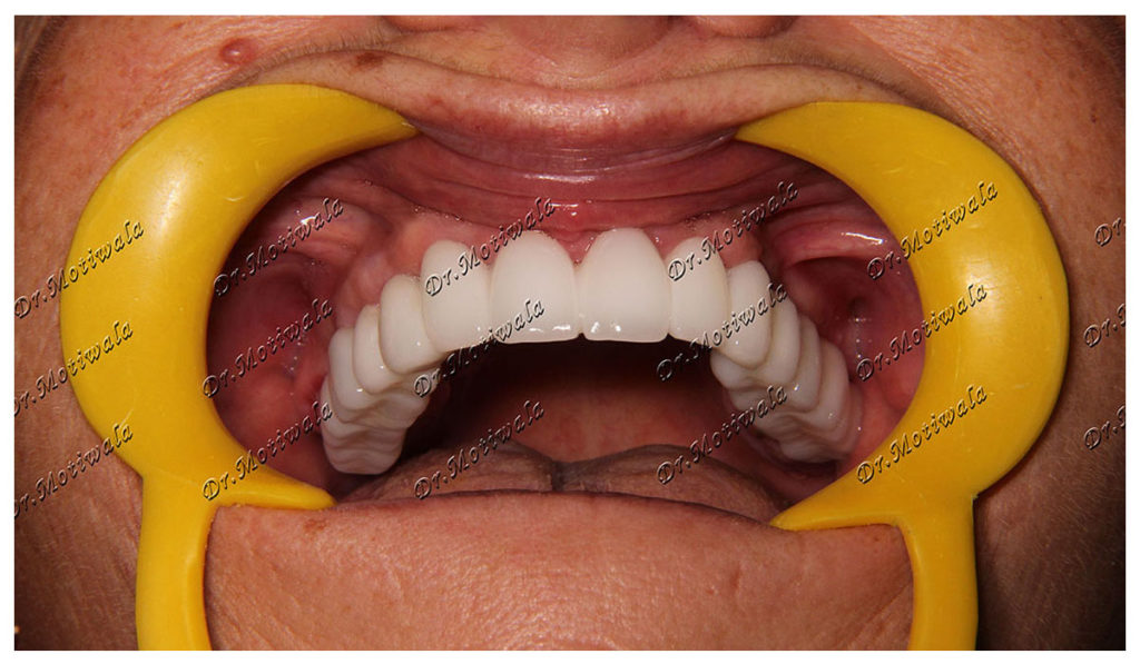 Bone graft for dental implants