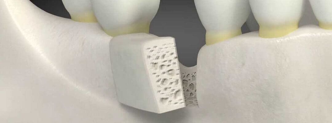 Dental Bone Graft Cost & Complications – Is It Worth It?