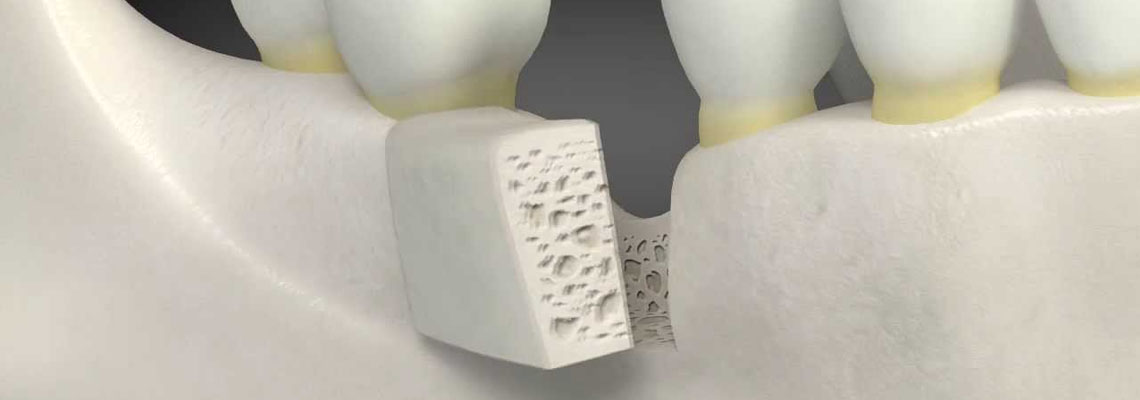 Dental bone graft cost