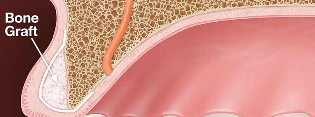 Dental bone graft cost in Australia