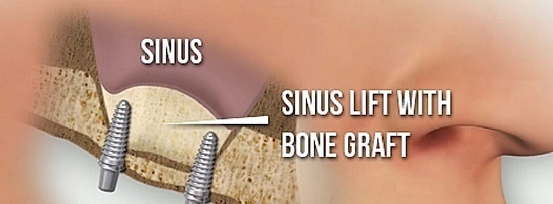 Sinus Lift Surgery in Canada