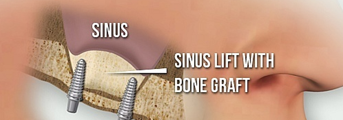 Sinus lift surgery in canada