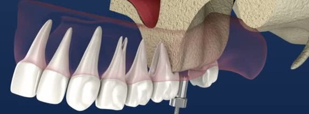 sinus lift surgery cost
