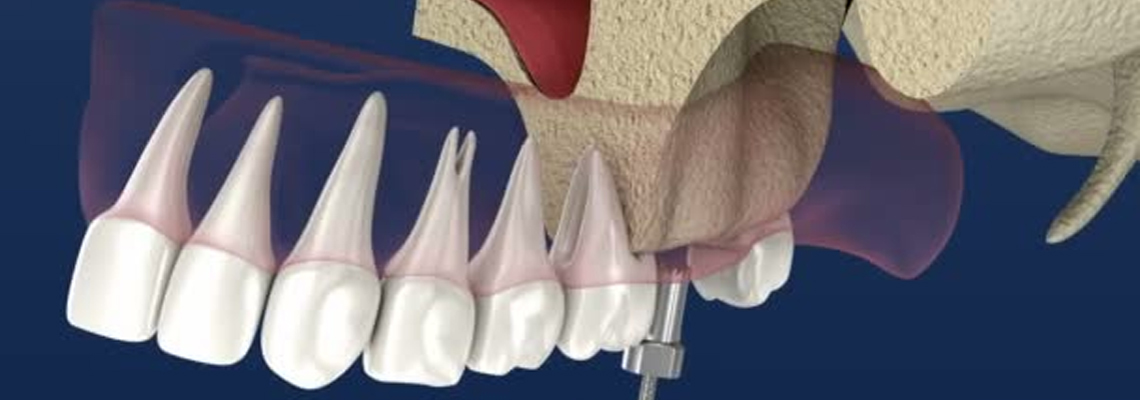 sinus lift surgery cost