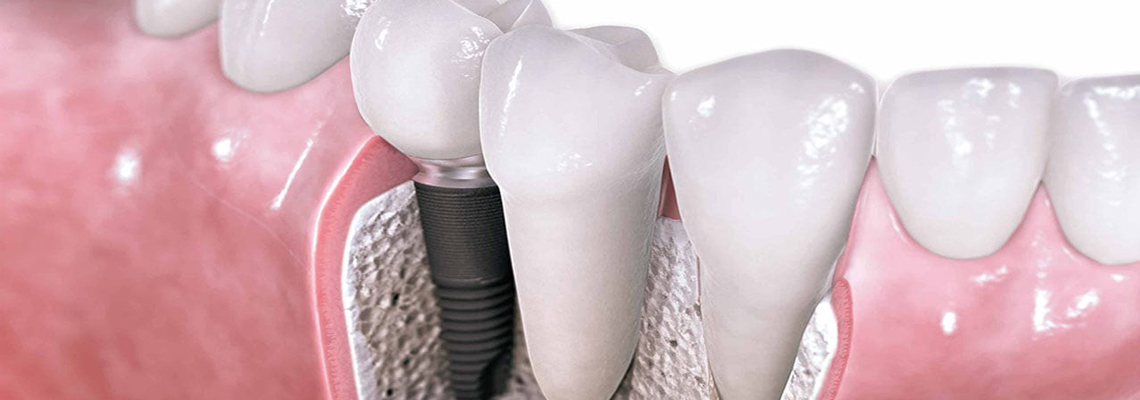 Dental implant surgery in hyderabad