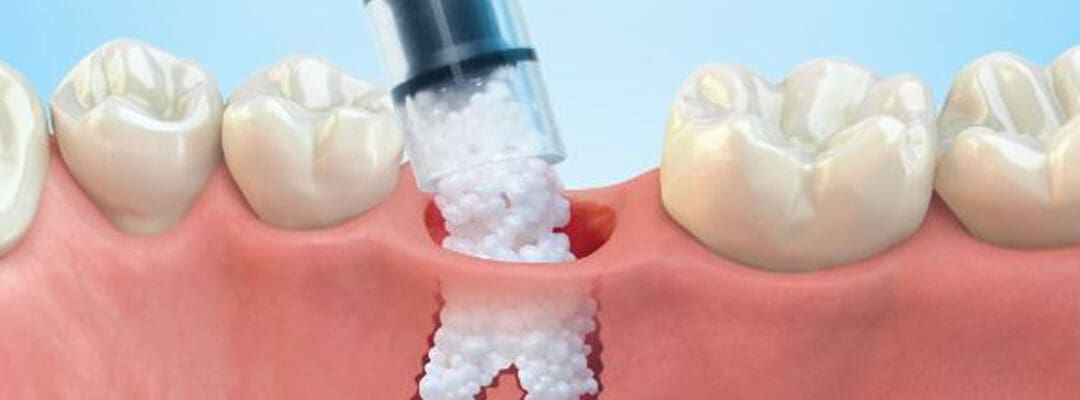 How to Save on Dental Bone Graft Cost?