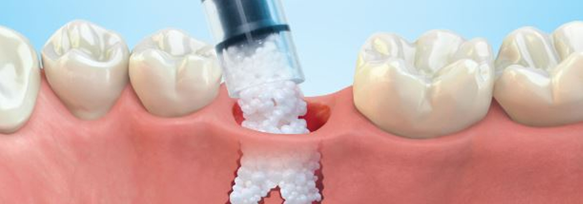 dental bone graft cost
