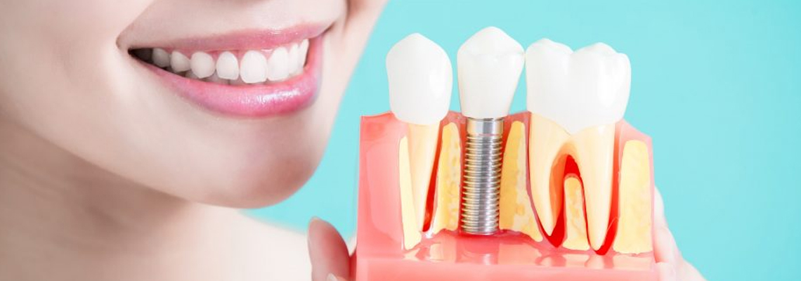 Permanent teeth implants in the USA