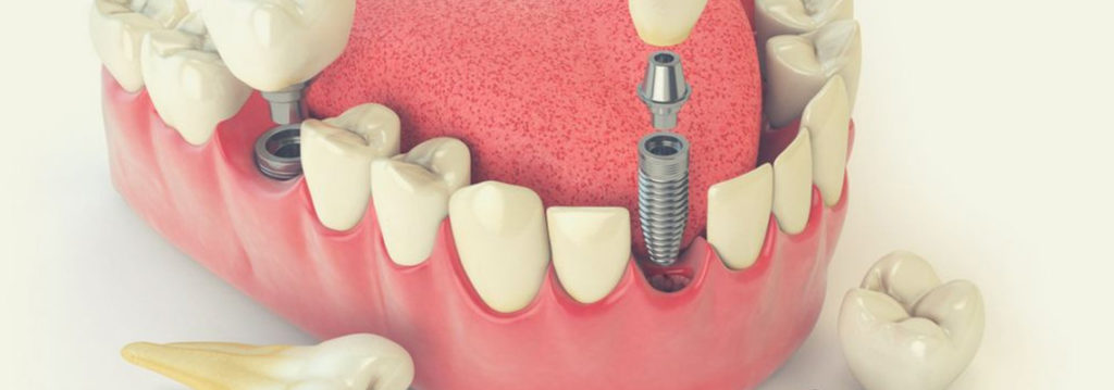 permanent teeth implants in UK