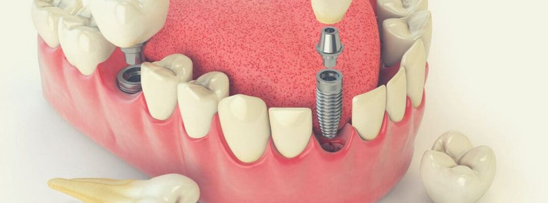 permanent teeth implants in UK