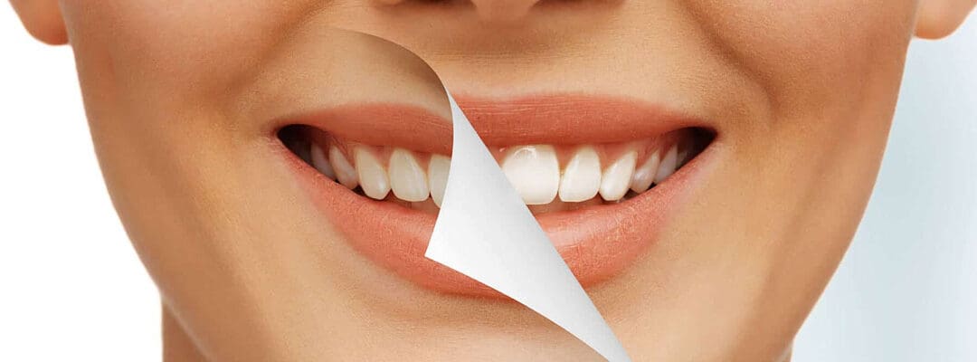 Full Mouth Restoration in Australia – Post Surgery Management