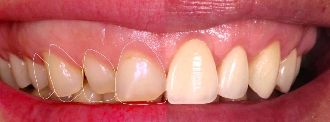 teeth makeover