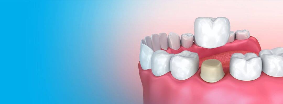 cost of crowns in India