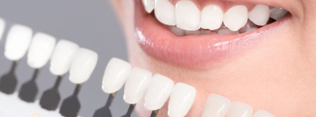 dental veneers cost in India