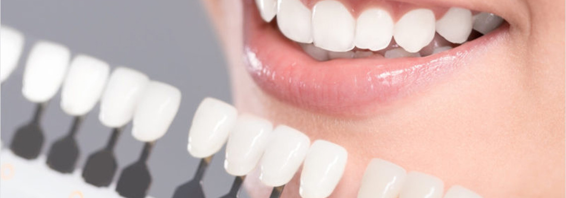 dental veneers cost in India