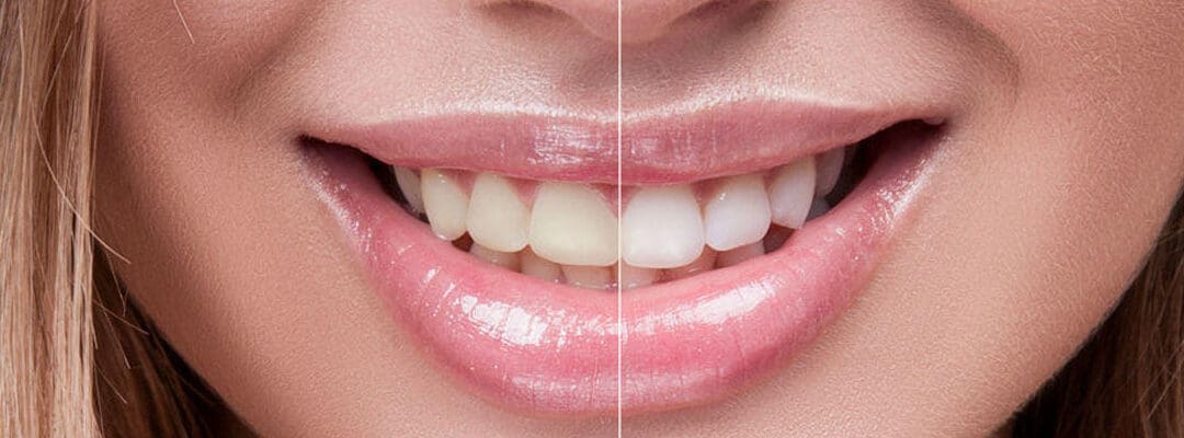 perfect smile dentistry