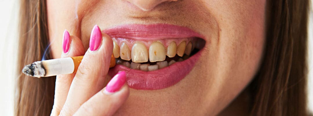 Effects of Smoking on Oral Health