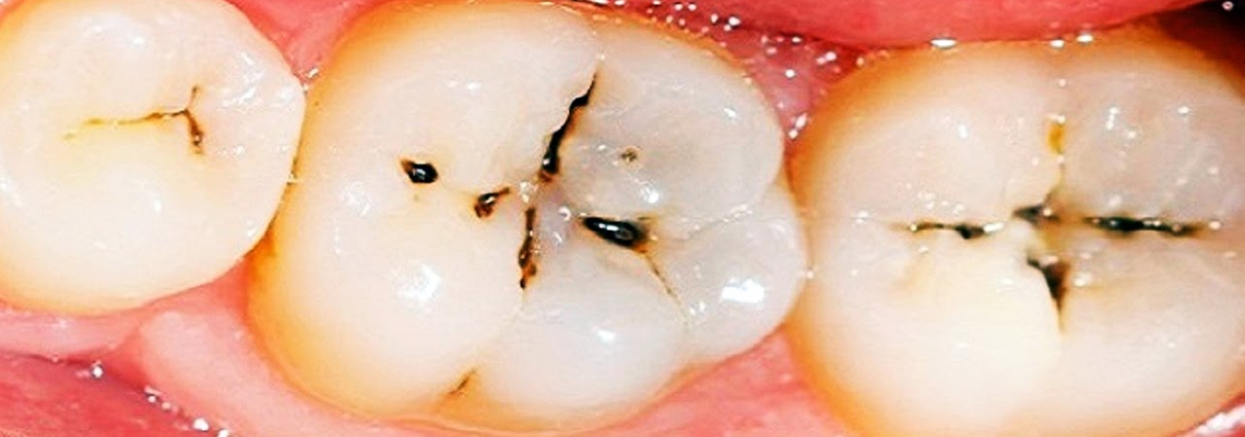 Dental Cavities