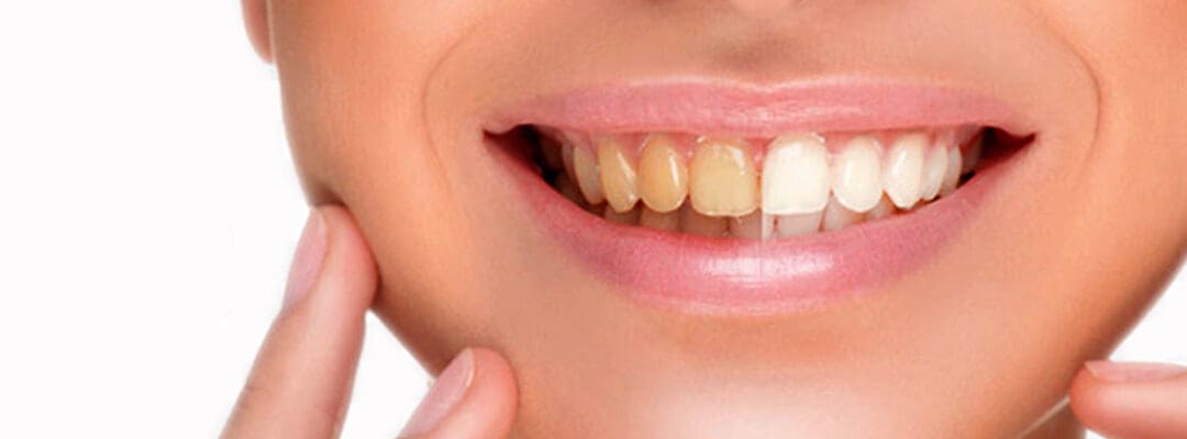 5 Myths About Teeth Whitening