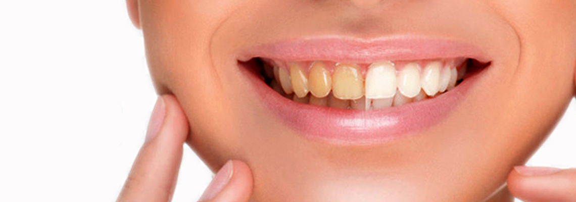 5 myths about teeth whitening