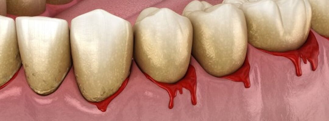 How to Take Care of Bleeding Gums?