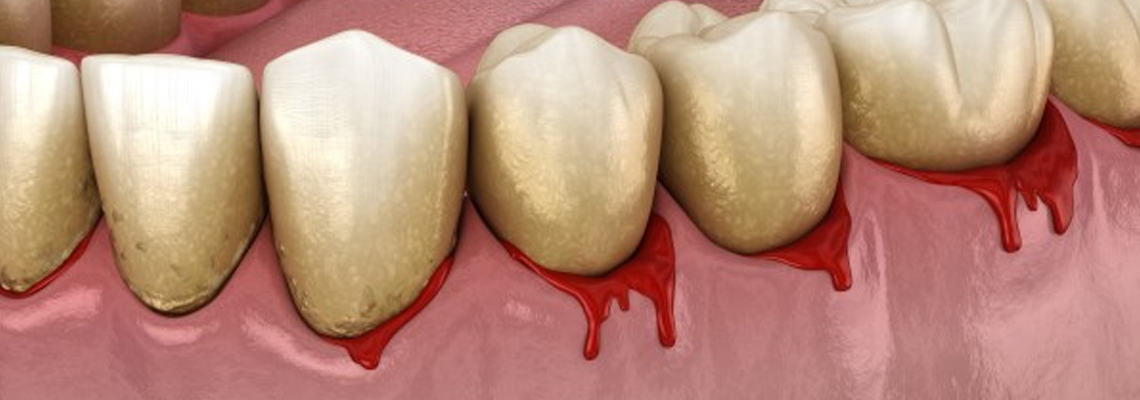 How to take care of bleeding gums?