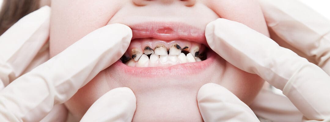Tooth Decay