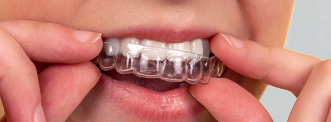 Signs You Need a New Retainer
