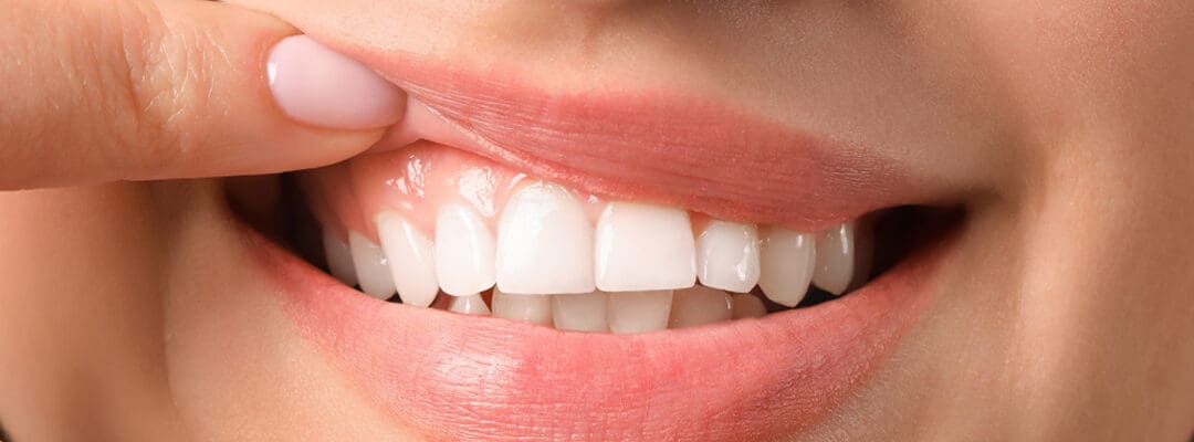 Recurring Swollen Gums & The Treatment