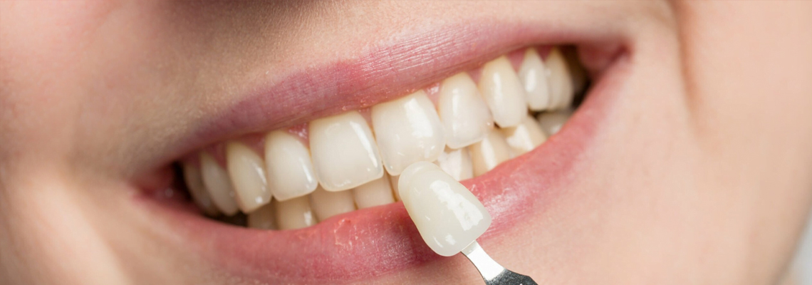 Care of dental veneers