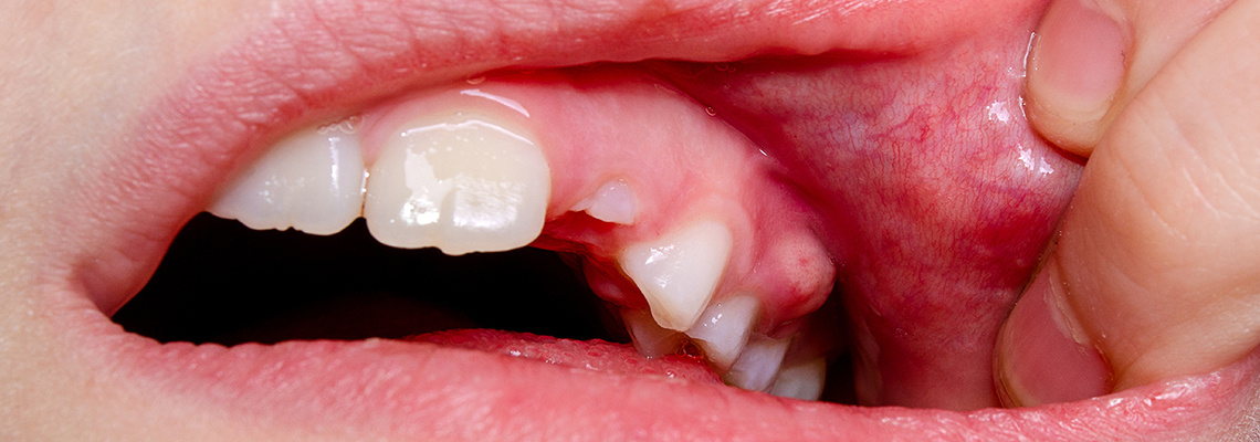 Causes of tooth abscess