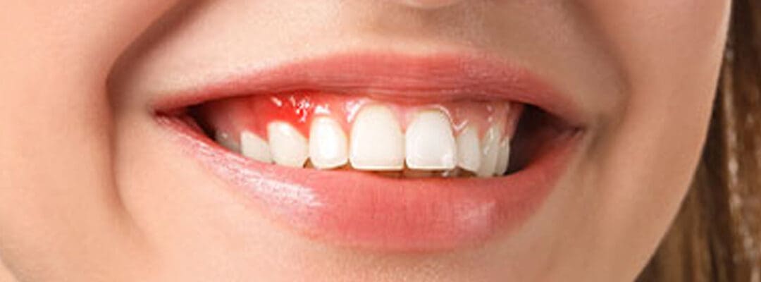 Causes of Bleeding Gums and Gum Disease