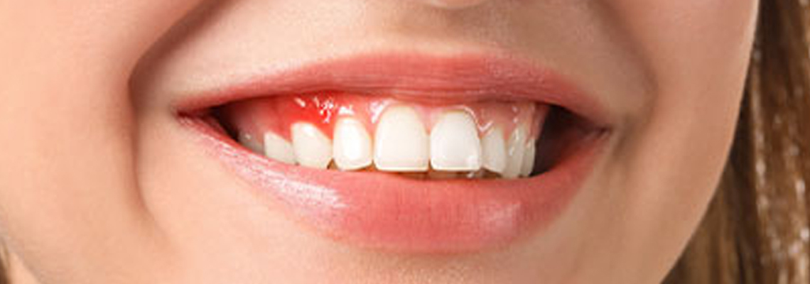 Causes of bleeding gums and gum disease