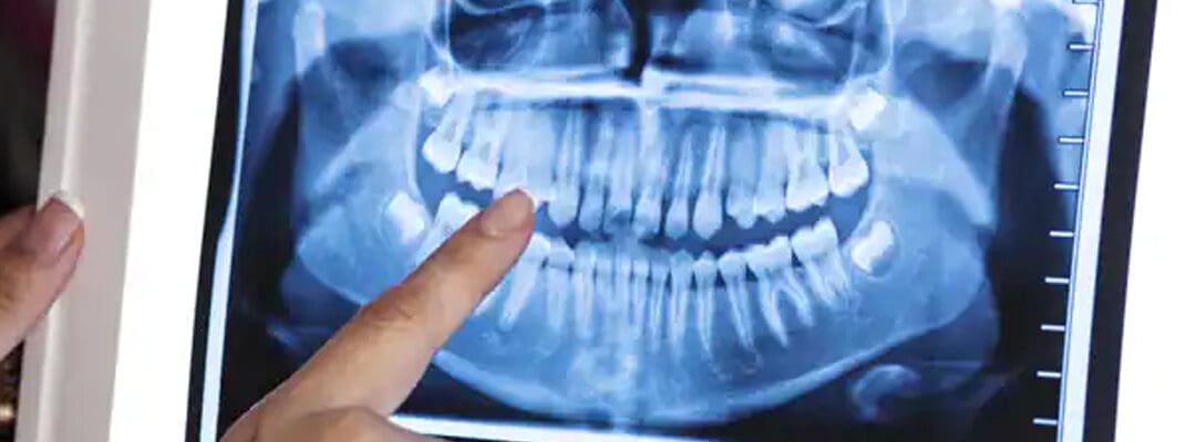 Hyperdontia: How to Treat Too Many Teeth?