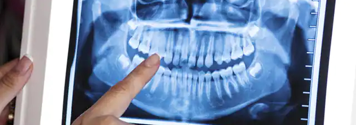 Hyperdontia: How to Treat Too Many Teeth?