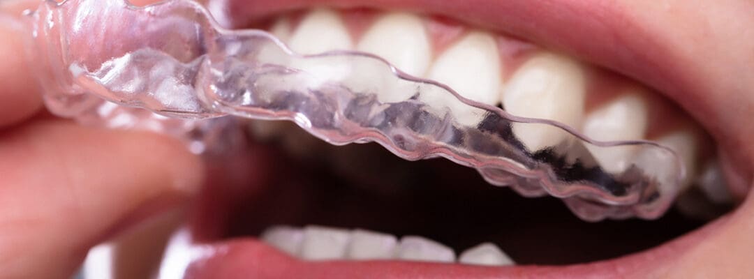 The Right Time to Straighten Your Teeth