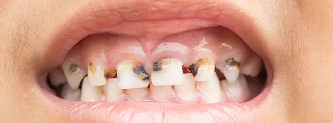 The Science Behind Tooth Decay