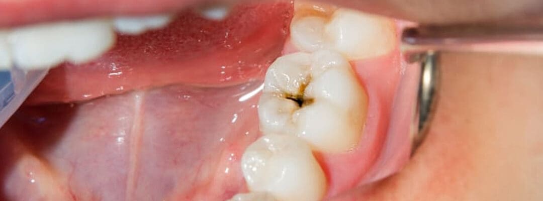 A Guide to Preventing Cavities