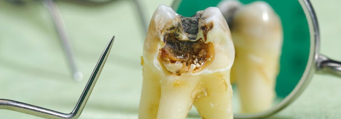 Tooth decay a threat you may not know about