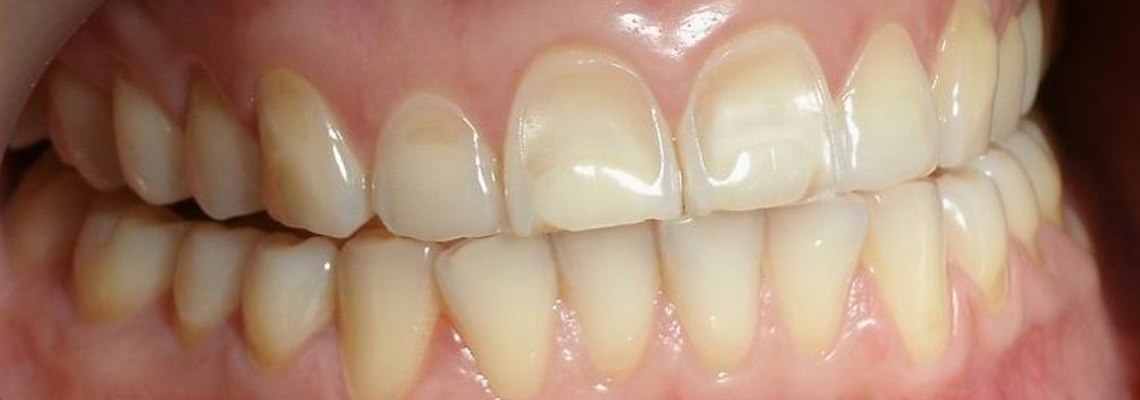 Tooth enamel loss erosion treatment