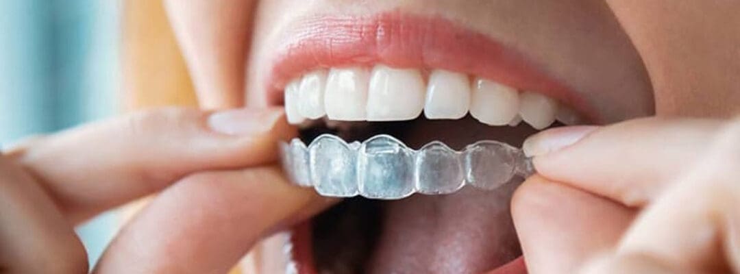 Invisible Braces: Straightening Your Smile Discreetly