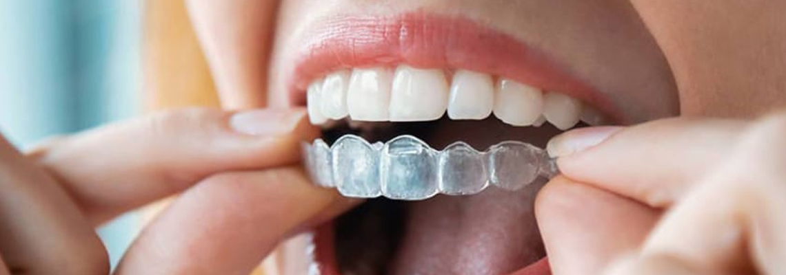 Invisible braces straightening your smile discreetly