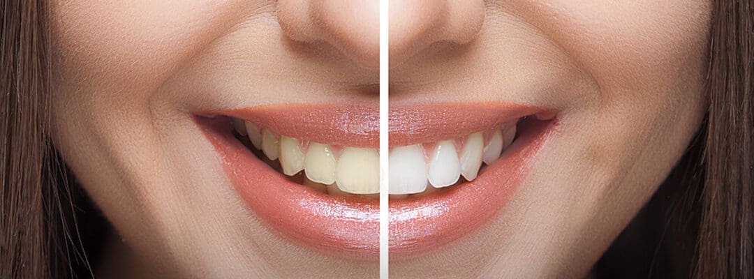 Teeth Whitening: Brighten Your Smile Safely & Effectively