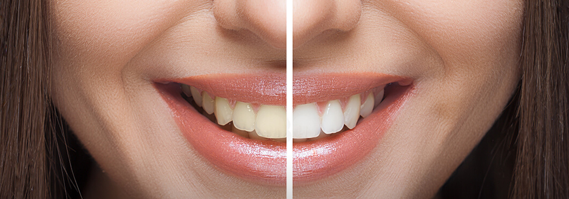 Teeth whitening: brighten your smile safely & effectively