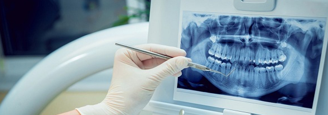 The role of advanced imaging in dental implants